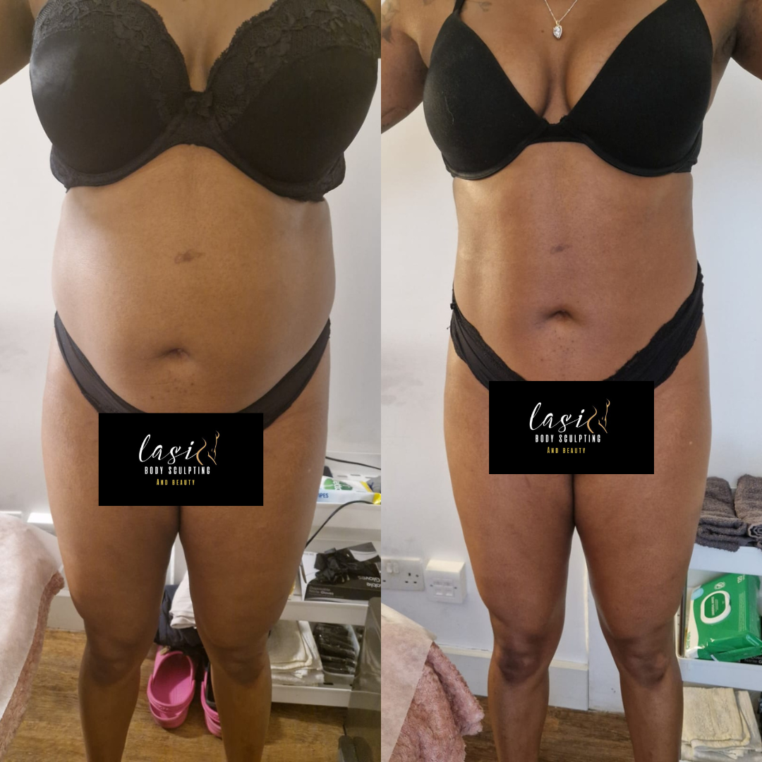 before and after mummy makeover bundle